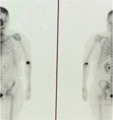 Transparency – a patient-centric view on radiopharmaceutical extravasations